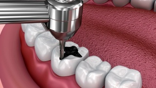 龋齿去除，牙裂填补，医学上准确的3D插图视频素材模板下载