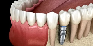 前磨牙种植修复。医学上精确的人类牙齿和假牙的三维动画概念