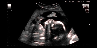 超声波检查，妊娠中期。医学检查显示