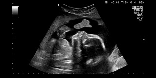 未出生的婴儿在子宫里竖起大拇指。体检显示，孕期超声检查