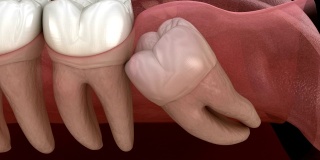 健康牙齿和智齿近中嵌塞。医学上准确的牙齿3D动画