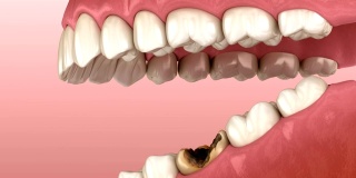 失去臼齿。3D动画的人的牙齿和假牙的概念