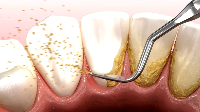 口腔卫生:超声波洁牙机，清除牙石和牙菌斑。医学上精确的人类牙齿治疗3D动画