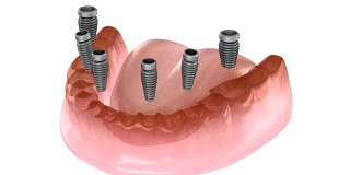 下颌骨假体全部在4个系统上，由种植体、螺钉固定。医学上精确的3D动画牙科概念