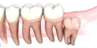 智齿纵、横、远端嵌顿。医学上准确的牙齿3D动画