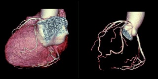 CTA冠状动脉三维渲染图像对比心脏三维和冠状动脉三维在屏幕上旋转，用于血管冠状动脉狭窄的诊断。