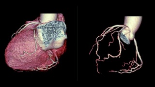 CTA冠状动脉三维渲染图像对比心脏三维和冠状动脉三维在屏幕上旋转，用于血管冠状动脉狭窄的诊断。视频素材模板下载