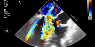 高品质影像超声经食管心脏检查。