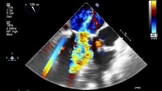 高品质影像超声经食管心脏检查。视频素材模板下载
