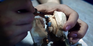 牙医在下巴上做假牙。牙医用手拿着一个下颌植入物，并用工具把它涂上。牙科的现代技术。特写,FullHD。