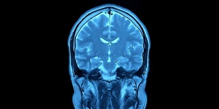 核磁共振成像扫描。人类的大脑。