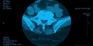 脊柱计算机断层扫描结果可视化。椎间盘筛检的水平切片