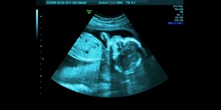 胚胎计算机扫描屏幕投。怀孕和产妇护理技术可视化