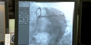 冠状动脉造影设备的筛选，移动心脏和血液