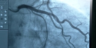 临床血管造影显示脉动静脉