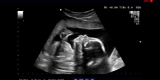 超声波检查，胎儿在子宫里
