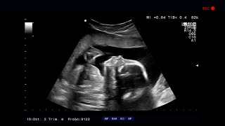 超声波检查，胎儿在子宫里视频素材模板下载