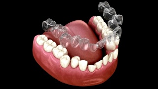 无牙套或隐形固位体可以进行咬合矫正。医学精准3D动画视频素材模板下载