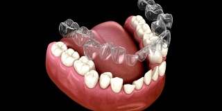 无牙套或隐形固位体可以进行咬合矫正。医学精准3D动画