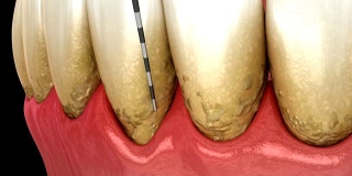 牙周炎测试，牙龈衰退过程。医学精准3D动画