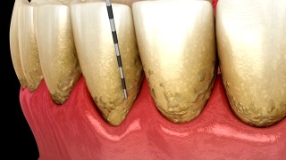 牙周炎测试，牙龈衰退过程。医学精准3D动画视频素材模板下载