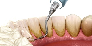 口腔卫生:超声波洁牙(常规牙周治疗)。医学上精确的人类牙齿治疗3D动画