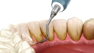 口腔卫生:超声波洁牙(常规牙周治疗)。医学上精确的人类牙齿治疗3D动画视频素材模板下载