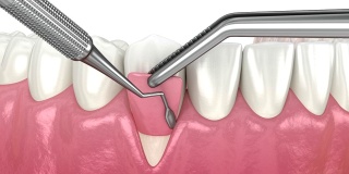 牙龈萎缩:软组织移植手术。牙科程序的3D动画