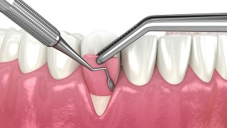 牙龈萎缩:软组织移植手术。牙科程序的3D动画视频素材模板下载
