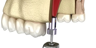 额窦提升手术。牙科手术的3D动画