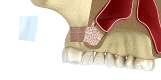 侧入路鼻窦提升术。牙科手术的3D动画