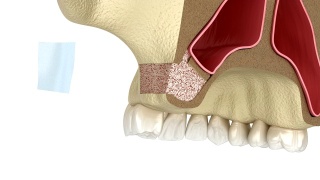 侧入路鼻窦提升术。牙科手术的3D动画视频素材模板下载