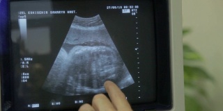 在超声波显示器上，人类胚胎正在轻微地移动他的头部