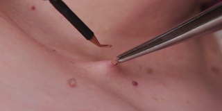 男医生用电动手术刀切除老年妇女的乳头状瘤