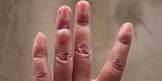 左手手指有无名指被开水烫伤的伤口