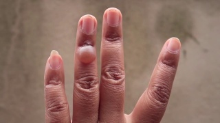 左手手指有无名指被开水烫伤的伤口视频素材模板下载