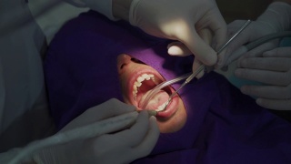牙科医生清洁口腔内的牙垢视频素材模板下载