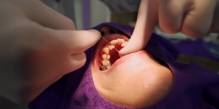牙科医生用牙线清洁牙齿上的牙石(牙垢)