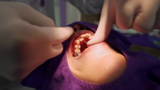 牙科医生用牙线清洁牙齿上的牙石(牙垢)视频素材模板下载