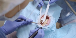牙科医生的手戴着蓝手套，在牙科诊所里治疗戴着保护装置的妇女的牙齿。保健和医学的概念。