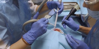 一个年轻的女人的特写镜头两个牙医在蓝色的手套治疗一个女人的牙齿戴保护在牙科办公室。保健和医学的概念。