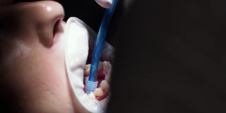 年轻女牙医在正畸医师接待处更换牙套抛光胶粘合