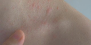 一根手指慢慢地划过皮肤表面。接触发炎的皮肤。皮肤上有大小不一的炎症。面部和颈部有皮疹。过敏性皮炎。特写镜头