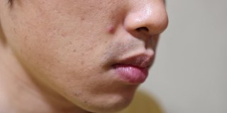 一个日本男人脸上的粉刺