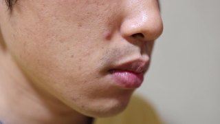 一个日本男人脸上的粉刺视频素材模板下载