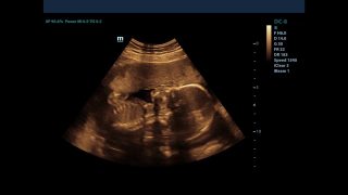 孕妇用超声波检查的记录，显示婴儿在动。在超声波扫描时婴儿会动。怀孕的概念视频素材模板下载