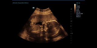 孕妇用超声波检查的记录，显示婴儿在动。在超声波扫描时婴儿会动。怀孕的概念