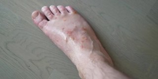 许多蚊子在腿上叮咬。过敏反应,皮炎。女人的手正在往皮肤上涂药膏