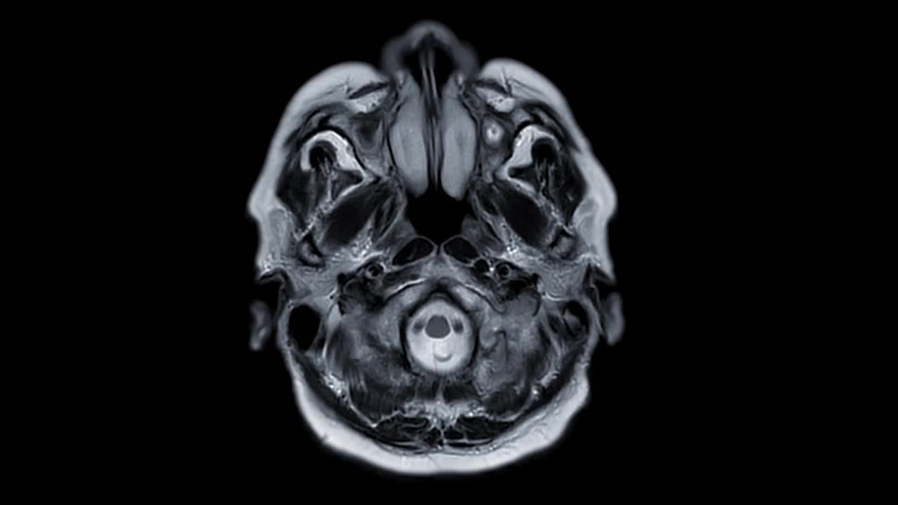 MRI脑或核磁共振成像(MRI)的脑轴t2诊断中风疾病。