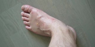 许多蚊子在腿上叮咬。过敏反应,皮炎。女人的手正在往皮肤上涂药膏